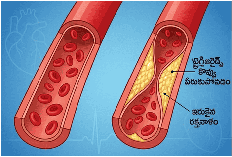 triglycerides
