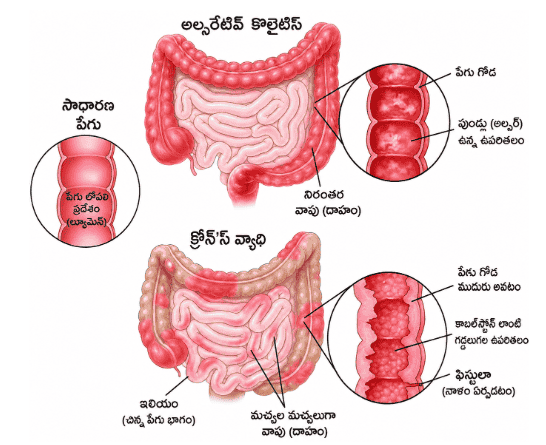 ulcerative colitis